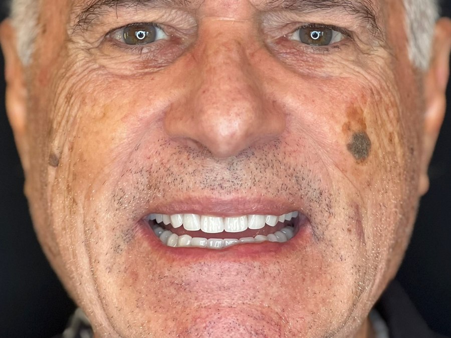 Sorriso reabilitado após extrações, enxerto ósseo e implantes na Clínica CZN