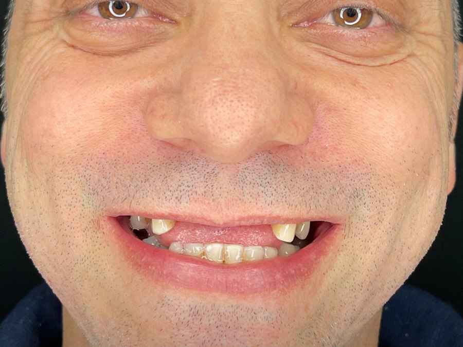 Sorriso com ausências dentárias antes da reabilitação com implantes na Clínica CZN