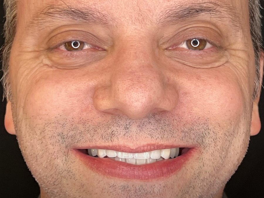 Sorriso reabilitado com implantes e coroas na Clínica CZN, Vila Mariana
