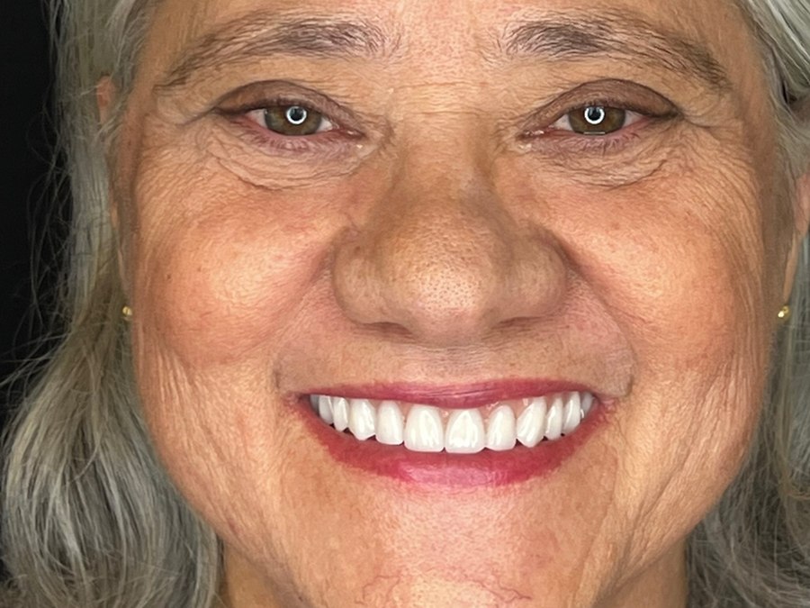Sorriso com prótese fixa sobre implantes nas duas arcadas na Clínica CZN