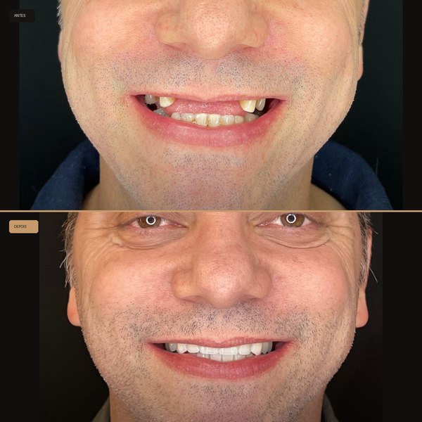 Antes e depois de reabilitação com implante na Clínica CZN, caso 1