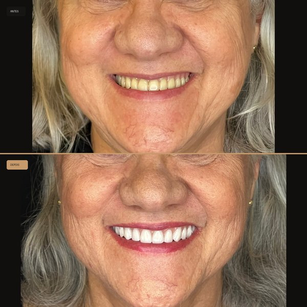 Antes e depois de reabilitação com implante na Clínica CZN, caso 2