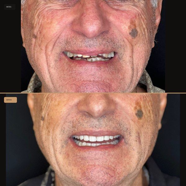 Antes e depois de reabilitação com implante na Clínica CZN, caso 3
