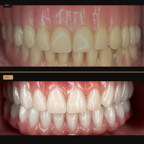 Antes e depois de reabilitação com implante na Clínica CZN, caso 4