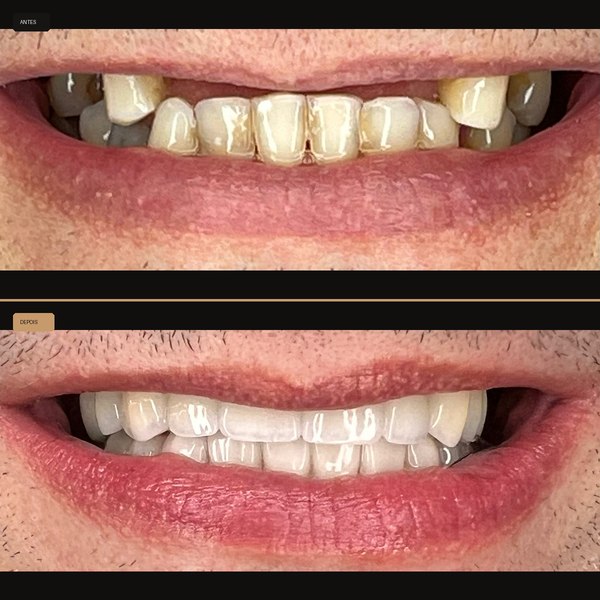 Antes e depois de reabilitação com implante na Clínica CZN, caso 5