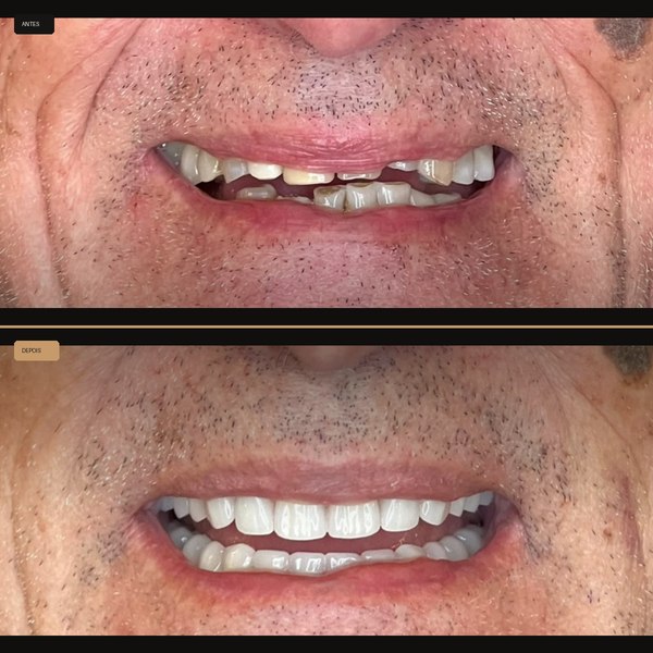 Antes e depois de reabilitação com implante na Clínica CZN, caso 6