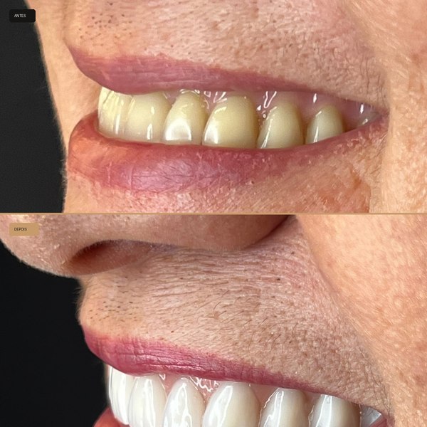 Antes e depois de reabilitação com implante na Clínica CZN, caso 7