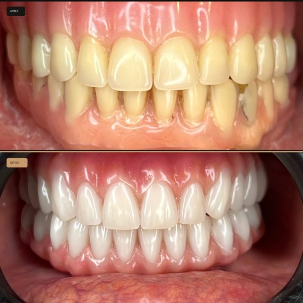 Antes e depois de reabilitação com implante na Clínica CZN, caso 8